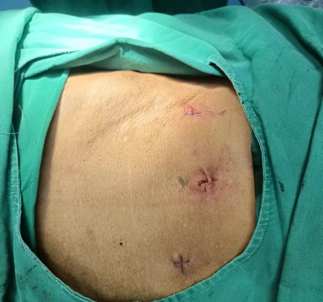 疝气补片怎么固定疝气“补丁” ｜ 腹腔镜下腹股沟疝修补术（TAPP）_https://www.jmylbn.com_新闻资讯_第5张