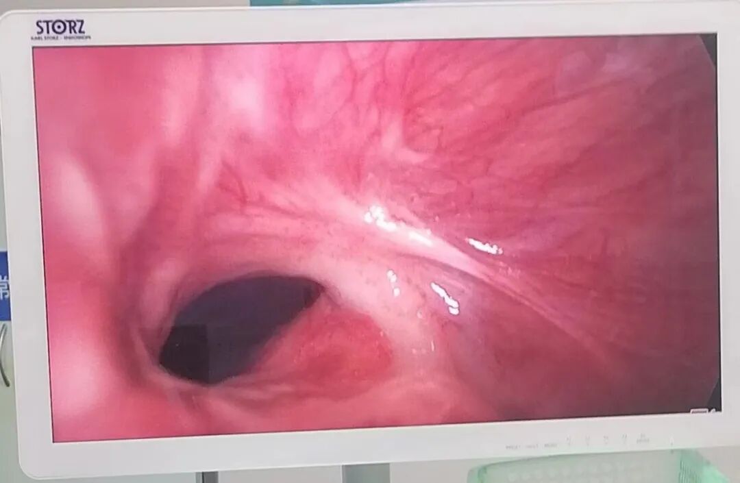 疝气补片怎么固定疝气“补丁” ｜ 腹腔镜下腹股沟疝修补术（TAPP）_https://www.jmylbn.com_新闻资讯_第3张