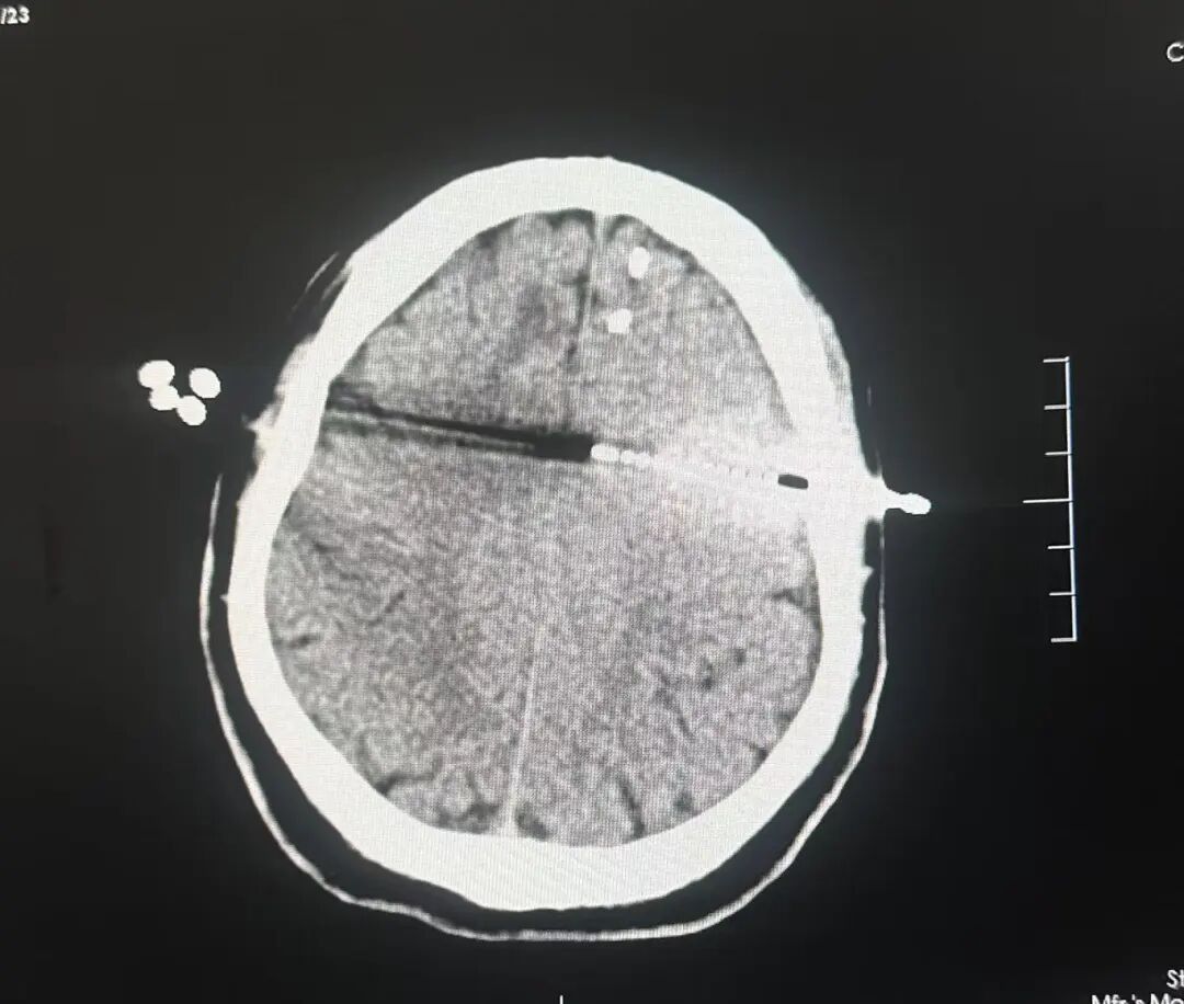 日本光电脑电图怎么样神经外科机器人精准定位治疗难治性癫痫_https://www.jmylbn.com_新闻资讯_第3张