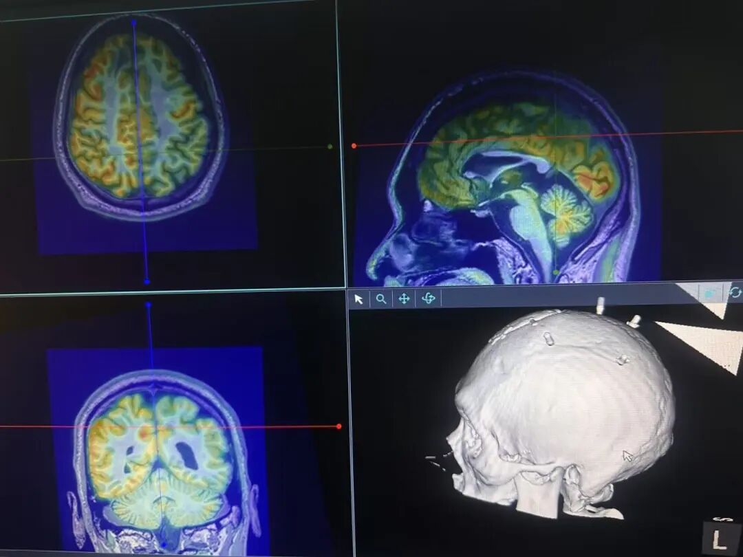 日本光电脑电图怎么样神经外科机器人精准定位治疗难治性癫痫_https://www.jmylbn.com_新闻资讯_第4张