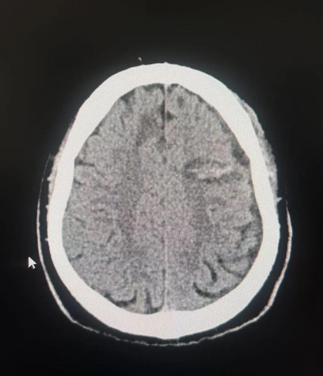 日本光电脑电图怎么样神经外科机器人精准定位治疗难治性癫痫_https://www.jmylbn.com_新闻资讯_第5张