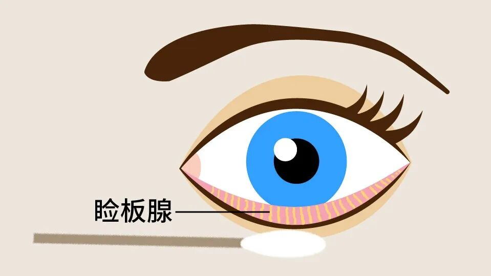 光热治疗仪有什么作用厦门眼科中心“睑板腺光热脉动VIP复合治疗仪全国培训中心”成立！引领干眼规范化诊疗迈进新高度_https://www.jmylbn.com_新闻资讯_第4张