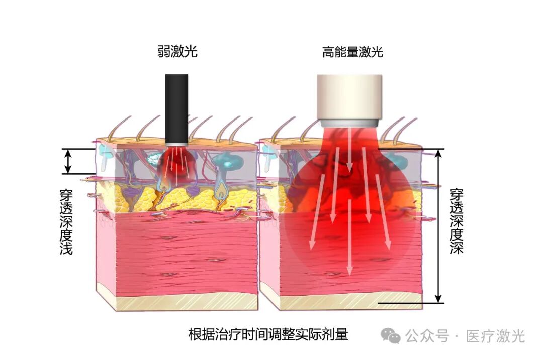康复治疗激光怎么收费【高能量激光】康复与疼痛治疗的＂无痛修复术＂——给饱受疼痛困扰患者的科学指南_https://www.jmylbn.com_新闻资讯_第2张