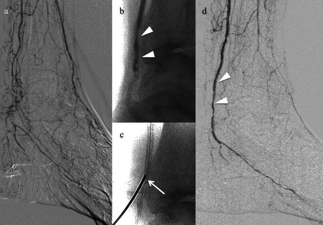 动脉钳怎么用动脉重度钙化导丝无法通过 针具技术超补救策略_https://www.jmylbn.com_新闻资讯_第13张
