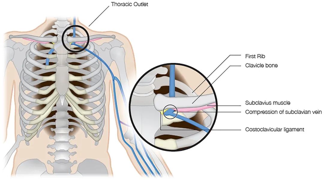 医学上ipc是什么米国静脉论坛上肢深静脉血栓临床指南与深度解析_https://www.jmylbn.com_新闻资讯_第14张