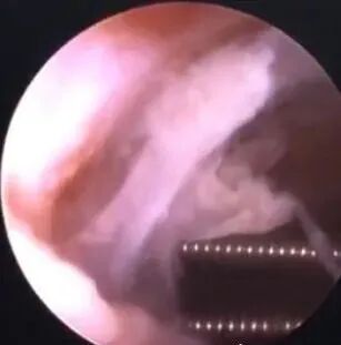 子宫支架怎么取一次性使用三角球囊子宫支架预防宫腔粘连较避孕环效果突出_https://www.jmylbn.com_新闻资讯_第3张