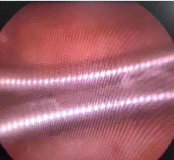 子宫支架怎么取一次性使用三角球囊子宫支架预防宫腔粘连较避孕环效果突出_https://www.jmylbn.com_新闻资讯_第1张