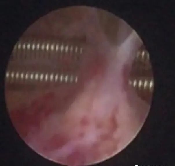 子宫支架怎么取一次性使用三角球囊子宫支架预防宫腔粘连较避孕环效果突出_https://www.jmylbn.com_新闻资讯_第2张