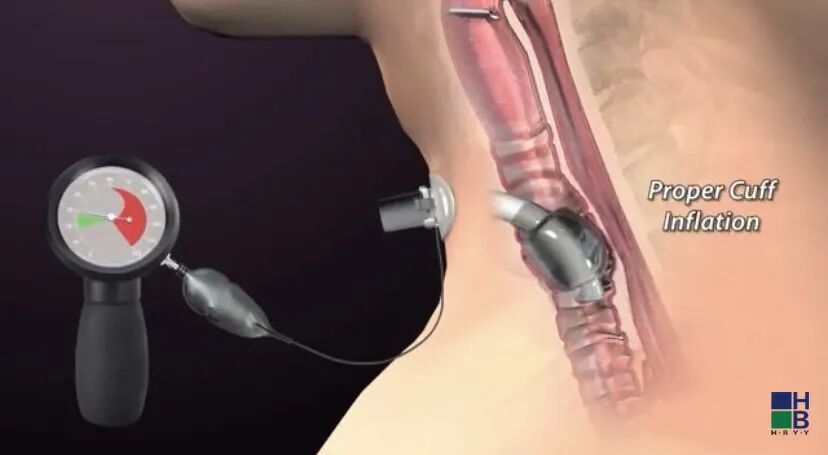 呼吸回路管怎么使用汇邦科普｜人工气道的气囊管理_https://www.jmylbn.com_新闻资讯_第1张