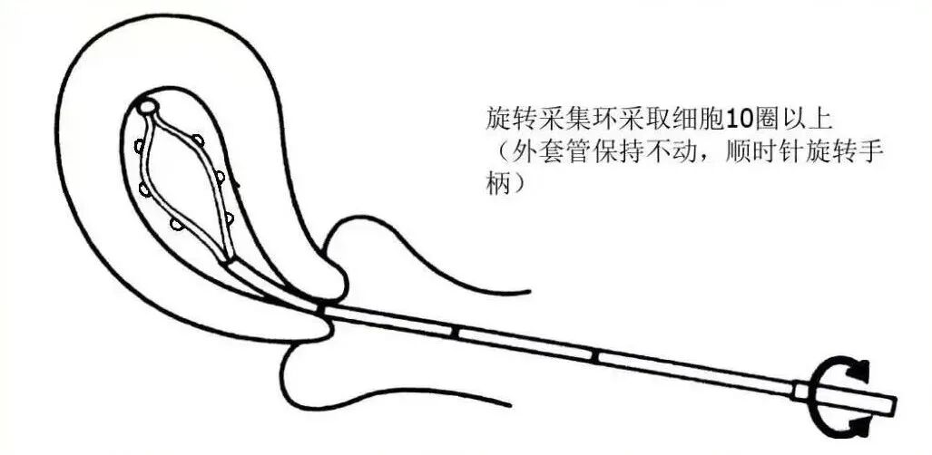 子宫内膜取样怎么取产品推荐｜子宫内膜细胞采集器_https://www.jmylbn.com_新闻资讯_第4张