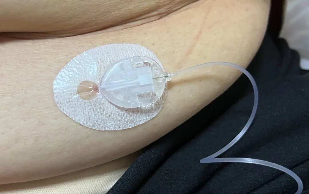 为什么要用泵打针智能控糖先锋——胰岛素泵，助您精准控糖无忧！_https://www.jmylbn.com_新闻资讯_第13张