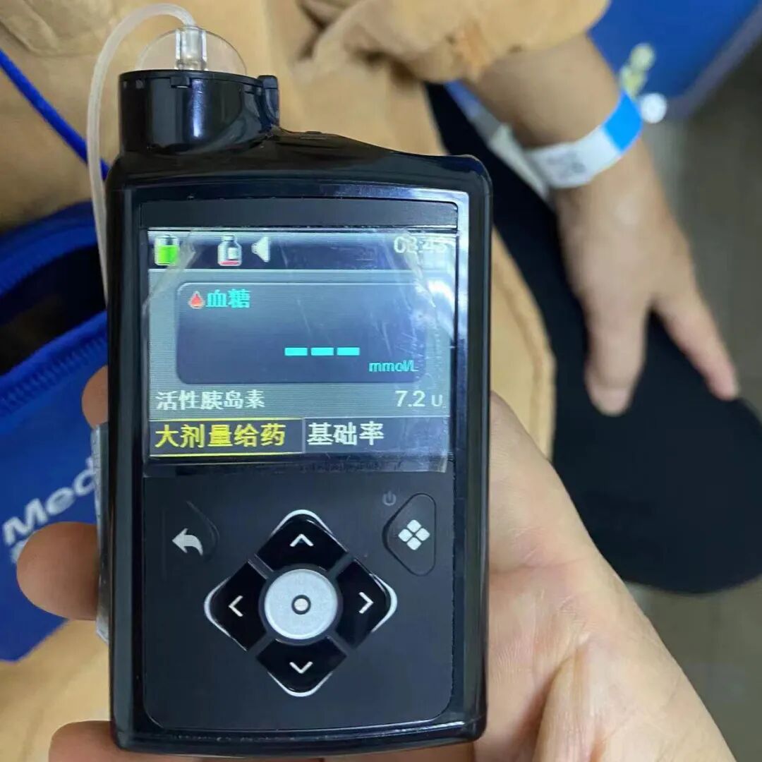 为什么要用泵打针智能控糖先锋——胰岛素泵，助您精准控糖无忧！_https://www.jmylbn.com_新闻资讯_第9张