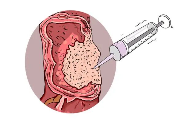 结肠灌洗怎么回事【病例分享】利用腹腔镜辅助术中灌洗技术解决结肠癌梗阻_https://www.jmylbn.com_新闻资讯_第3张