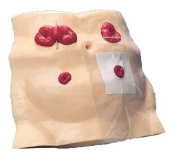 结肠灌洗怎么回事【病例分享】利用腹腔镜辅助术中灌洗技术解决结肠癌梗阻_https://www.jmylbn.com_新闻资讯_第5张