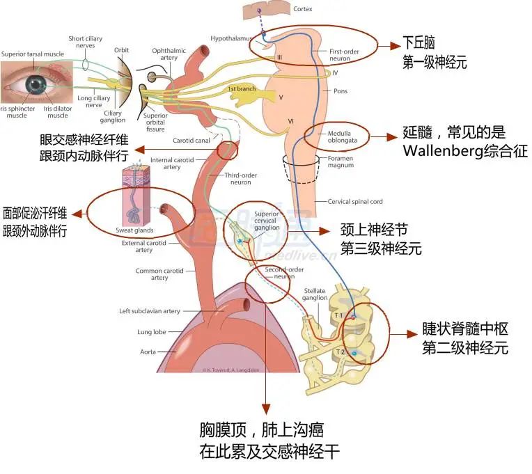 霍纳综合征（horner综合征）