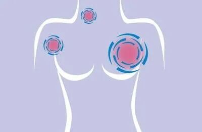 "乳腺癌患者必看！依西美坦如何精准狙击雌激素？医生不愿透露的3个关键机制(图8)