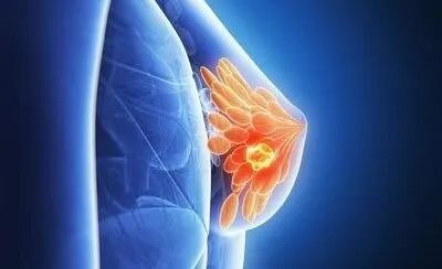 "乳腺癌患者必看！依西美坦如何精准狙击雌激素？医生不愿透露的3个关键机制(图7)