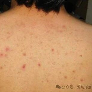 中医治疗毛囊炎偏方