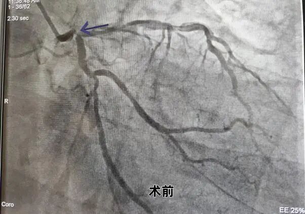 桡动脉鞘怎么读我院介入团队利用桡动脉无鞘技术及主动脉内球囊反搏技术处理高危左主干分叉病变，帮助病人“重获心生”_https://www.jmylbn.com_新闻资讯_第4张