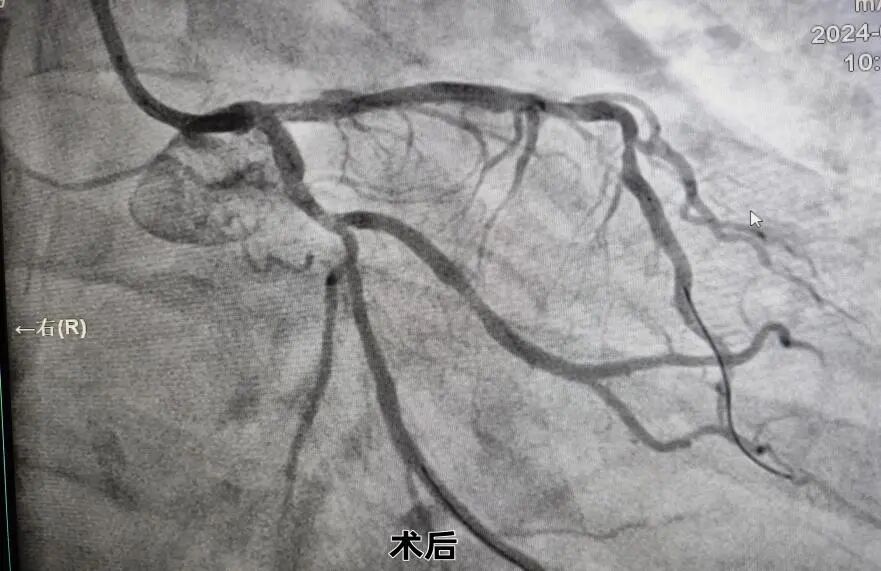 桡动脉鞘怎么读我院介入团队利用桡动脉无鞘技术及主动脉内球囊反搏技术处理高危左主干分叉病变，帮助病人“重获心生”_https://www.jmylbn.com_新闻资讯_第6张