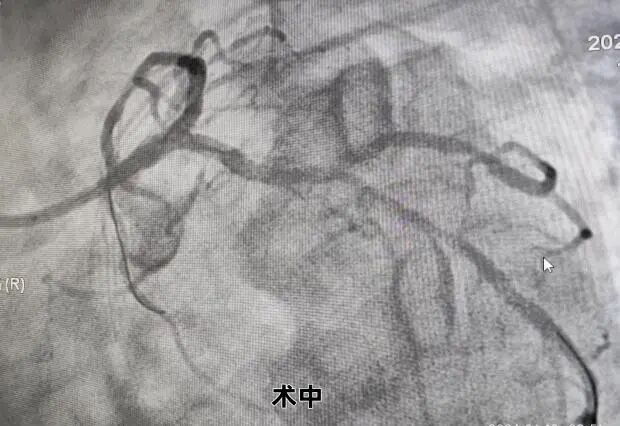 桡动脉鞘怎么读我院介入团队利用桡动脉无鞘技术及主动脉内球囊反搏技术处理高危左主干分叉病变，帮助病人“重获心生”_https://www.jmylbn.com_新闻资讯_第5张