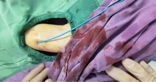 桡动脉鞘怎么读我院介入团队利用桡动脉无鞘技术及主动脉内球囊反搏技术处理高危左主干分叉病变，帮助病人“重获心生”_https://www.jmylbn.com_新闻资讯_第3张