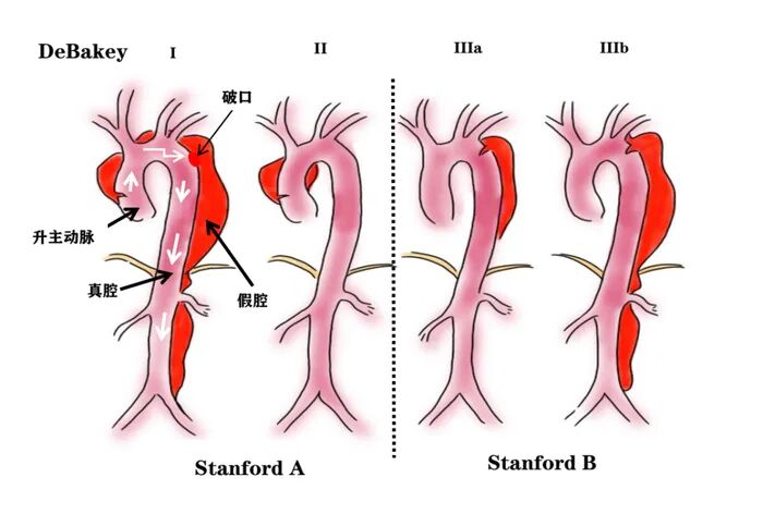 为什么有主动脉夹层分型，有哪几种分型，这篇给你讲明白了！