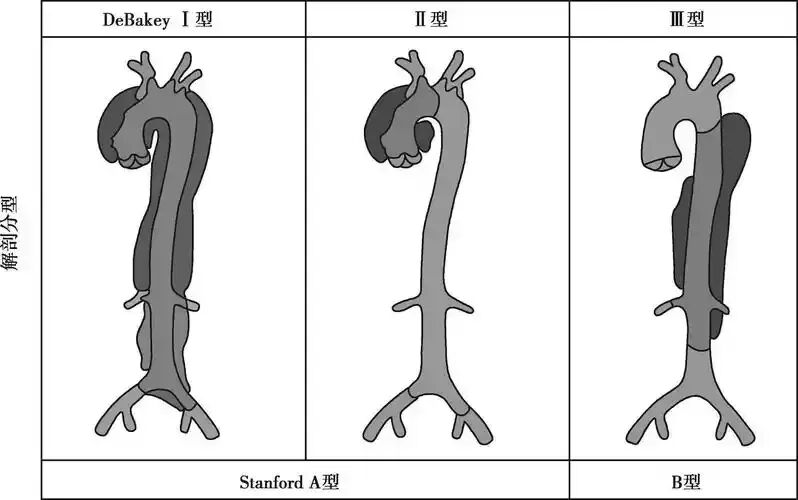 为什么有主动脉夹层分型，有哪几种分型，这篇给你讲明白了！