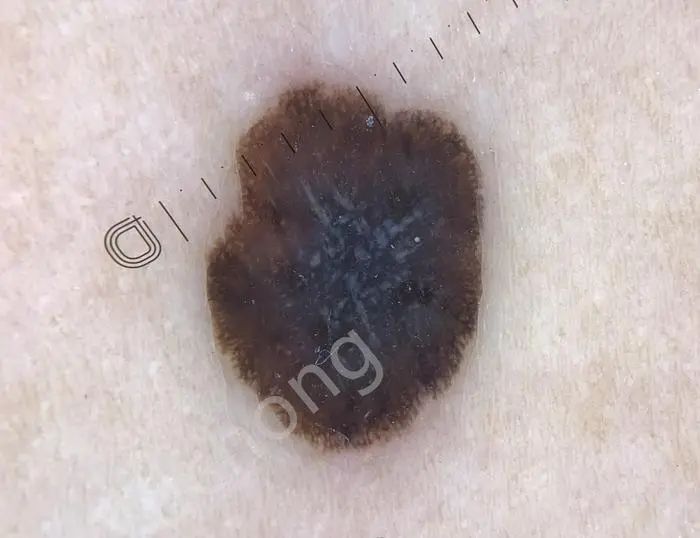 如何早期发现恶性黑色素瘤：从三例不同早期患者的诊断谈医生体会