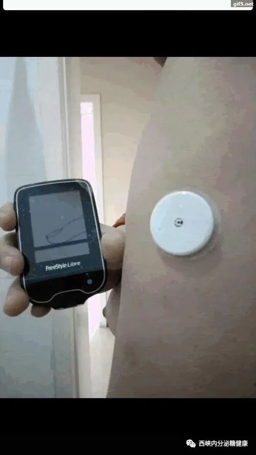 无痛采血针怎么用血糖监测扎手指真痛！无痛采血你知道吗？_https://www.jmylbn.com_新闻资讯_第17张