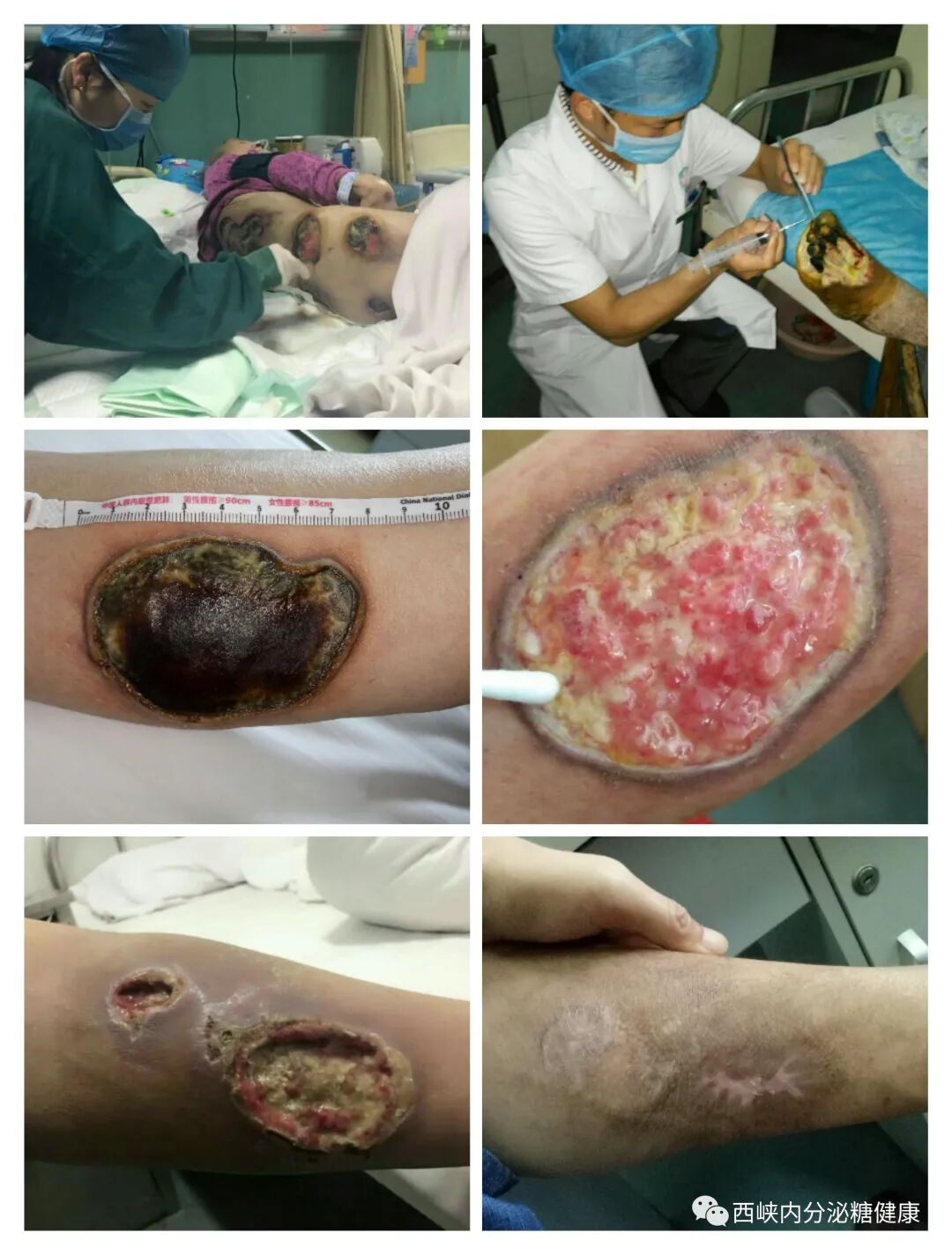 无痛采血针怎么用血糖监测扎手指真痛！无痛采血你知道吗？_https://www.jmylbn.com_新闻资讯_第25张