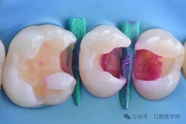 深龋：保守性单次就诊处理