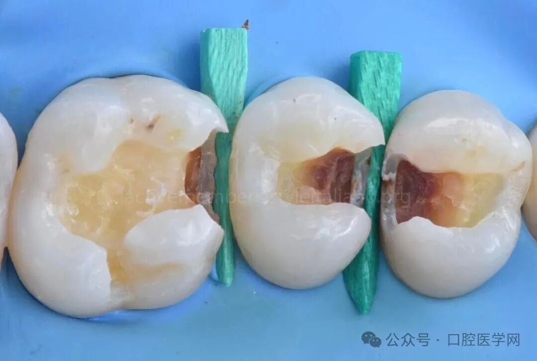 深龋：保守性单次就诊处理