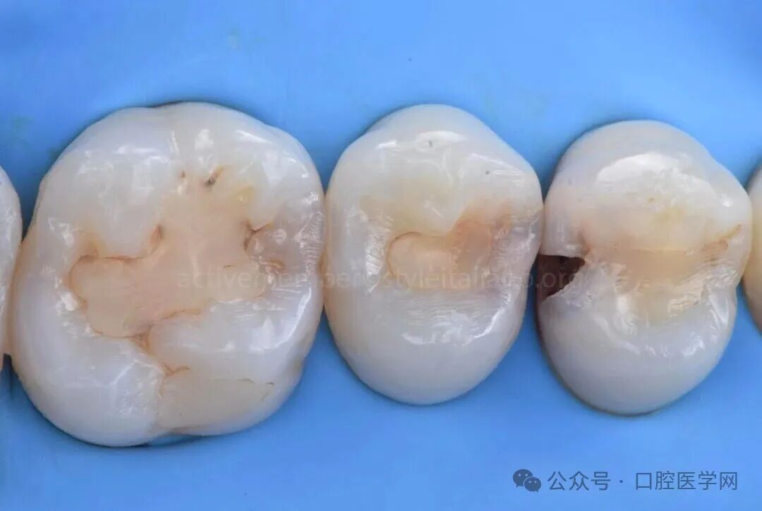 深龋：保守性单次就诊处理