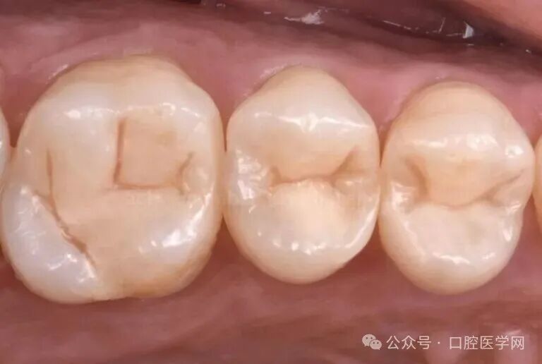 深龋：保守性单次就诊处理