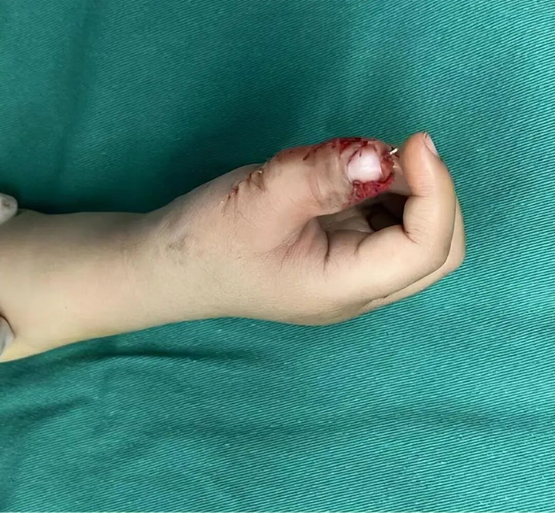 手术钳子怎么拿2岁孩子手指像“螃蟹钳子”？原因竟是..._https://www.jmylbn.com_新闻资讯_第5张