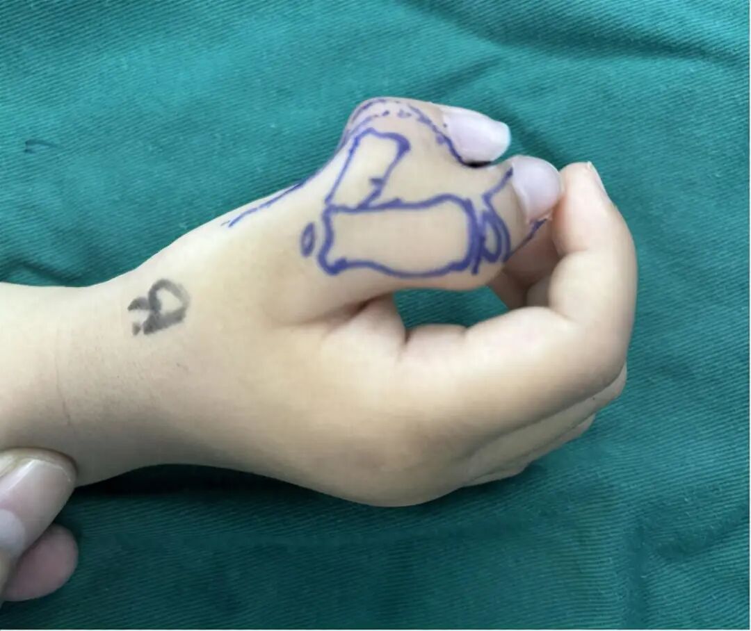 手术钳子怎么拿2岁孩子手指像“螃蟹钳子”？原因竟是..._https://www.jmylbn.com_新闻资讯_第4张