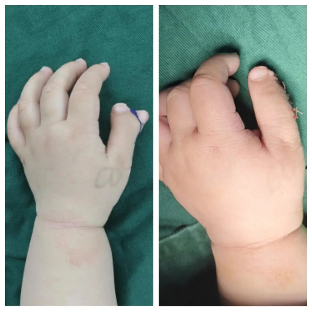 手术钳子怎么拿2岁孩子手指像“螃蟹钳子”？原因竟是..._https://www.jmylbn.com_新闻资讯_第7张