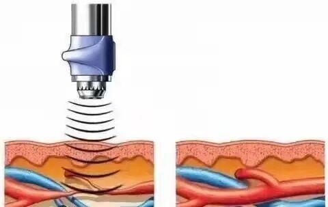 冲击波治疗是什么原理冲击波治疗的原理是什么？真的可以快速有效地解决疼痛吗？_https://www.jmylbn.com_新闻资讯_第1张