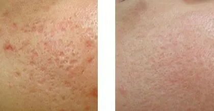 二氧化碳(co2)激光治疗是什么二氧化碳（CO₂）点阵激光，除了治疗痘坑还有哪些功能？_https://www.jmylbn.com_新闻资讯_第13张