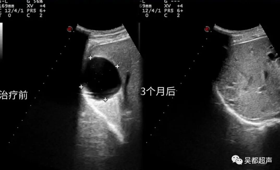 手术超声是什么超声介入日间手术——肝肾囊肿超微创治疗24小时出院-上海聚慕医疗器械有限公司