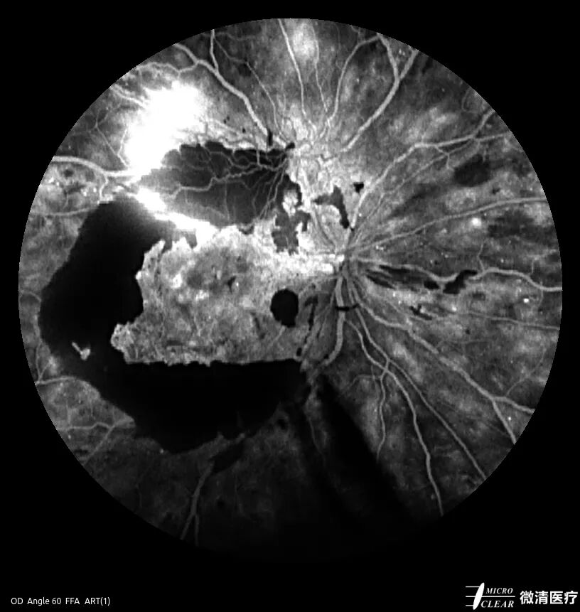 眼底激光机有什么牌子无法取代！超广角激光眼底血管造影(FFA)全面揭示眼底荧光异常的表现_https://www.jmylbn.com_新闻资讯_第7张