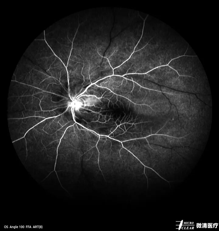 眼底激光机有什么牌子无法取代！超广角激光眼底血管造影(FFA)全面揭示眼底荧光异常的表现_https://www.jmylbn.com_新闻资讯_第10张