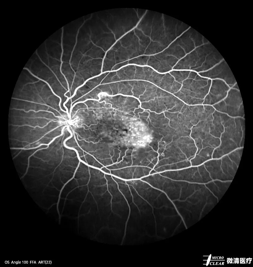眼底激光机有什么牌子无法取代！超广角激光眼底血管造影(FFA)全面揭示眼底荧光异常的表现_https://www.jmylbn.com_新闻资讯_第6张