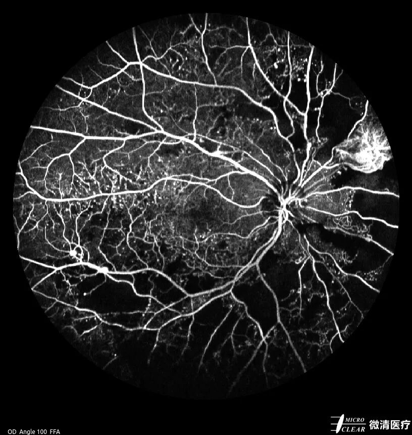 眼底激光机有什么牌子无法取代！超广角激光眼底血管造影(FFA)全面揭示眼底荧光异常的表现_https://www.jmylbn.com_新闻资讯_第9张