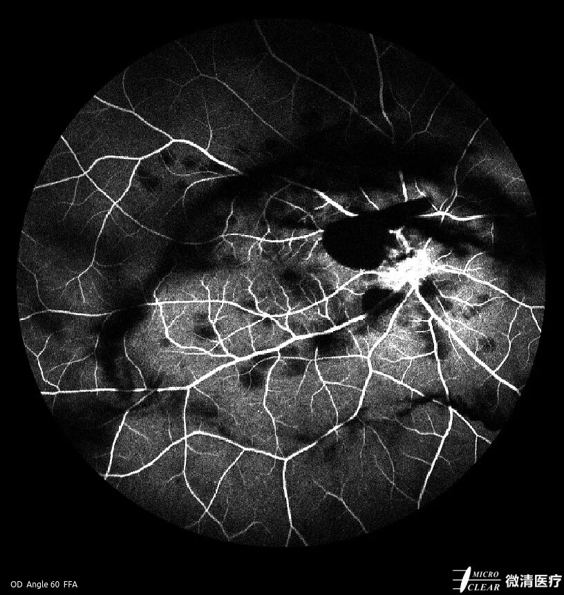 眼底激光机有什么牌子无法取代！超广角激光眼底血管造影(FFA)全面揭示眼底荧光异常的表现_https://www.jmylbn.com_新闻资讯_第8张