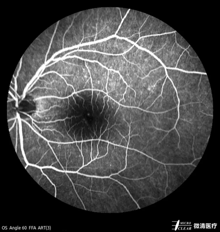 眼底激光机有什么牌子无法取代！超广角激光眼底血管造影(FFA)全面揭示眼底荧光异常的表现_https://www.jmylbn.com_新闻资讯_第3张