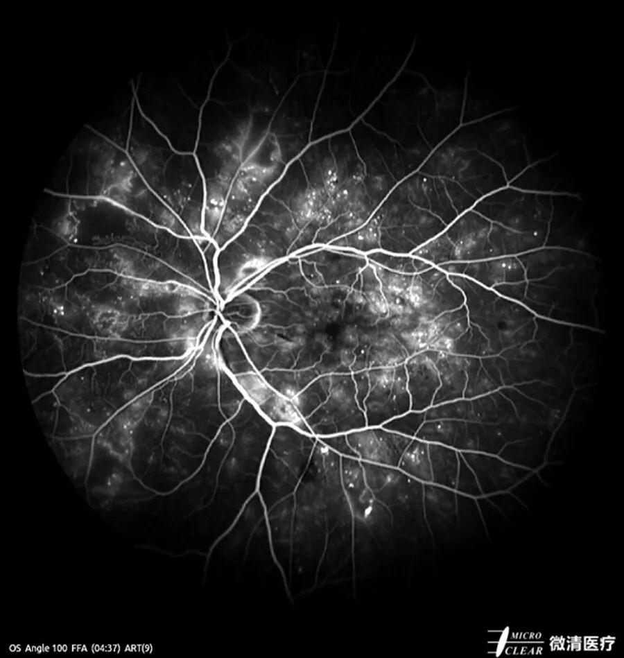 眼底激光机有什么牌子无法取代！超广角激光眼底血管造影(FFA)全面揭示眼底荧光异常的表现_https://www.jmylbn.com_新闻资讯_第4张