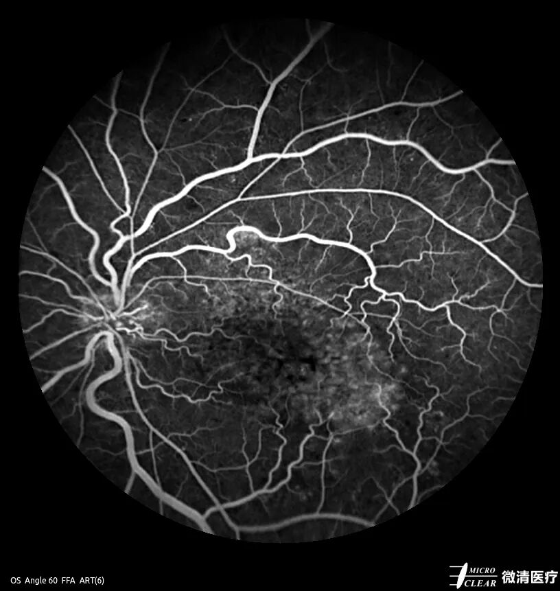 眼底激光机有什么牌子无法取代！超广角激光眼底血管造影(FFA)全面揭示眼底荧光异常的表现_https://www.jmylbn.com_新闻资讯_第5张