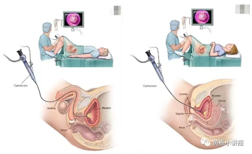 b膀胱镜为什么消毒什么是膀胱镜检查_https://www.jmylbn.com_新闻资讯_第1张
